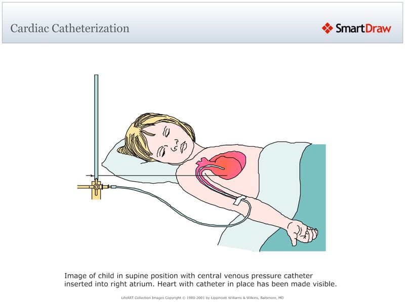 Cardiac_Catheterization