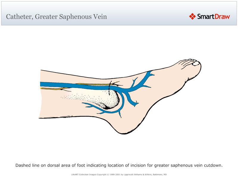 Catheter,_Greater_Saphenous_Vein