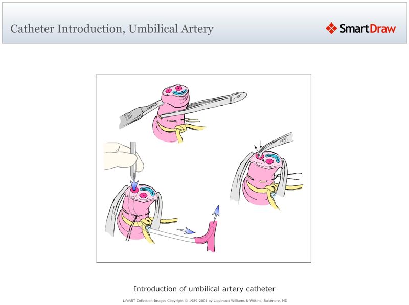 Catheter_Introduction,_Umbilical_Artery