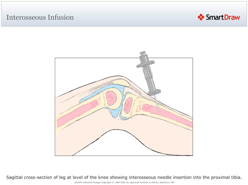 Interosseous_Infusion