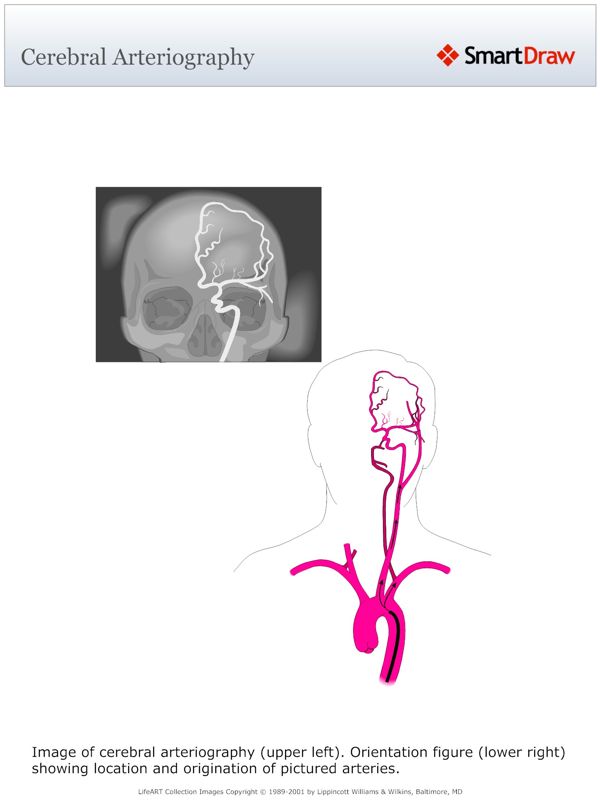 Cerebral_Arteriography