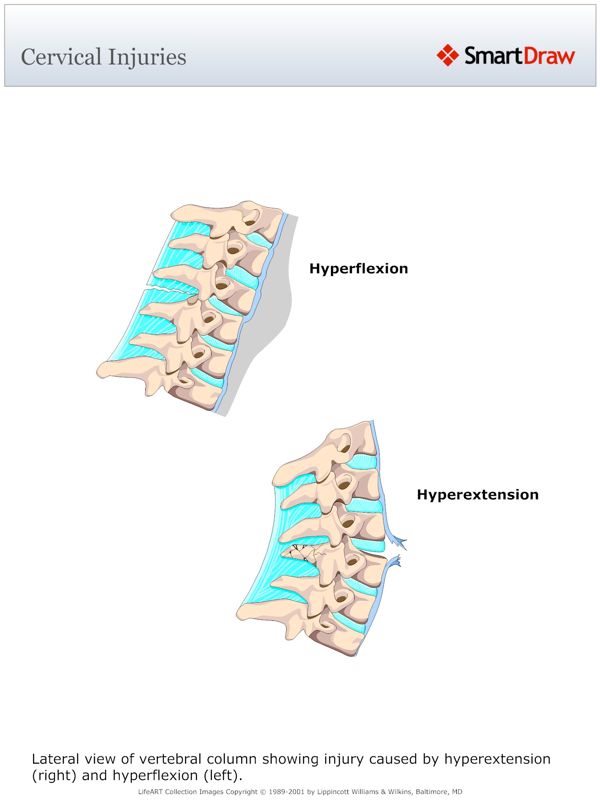 Cervical_Injuries
