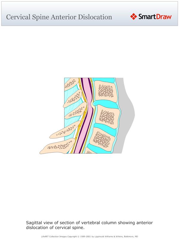 Cervical_Spine_Anterior_Dislocation