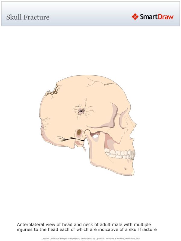 Skull_Fracture