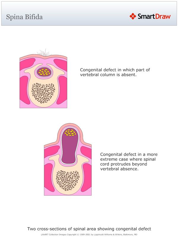 Spina_Bifida