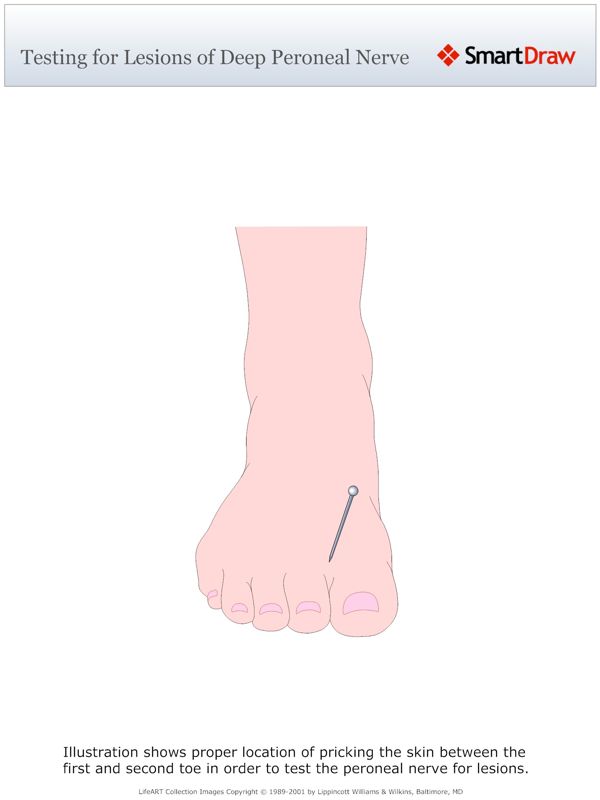 Testing_for_Lesions_of_Deep_Peroneal_Nerve