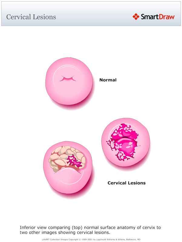 Cervical_Lesions