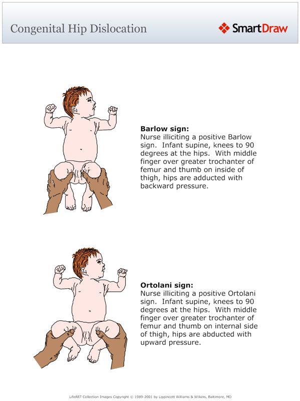 Congenital_Hip_Dislocation
