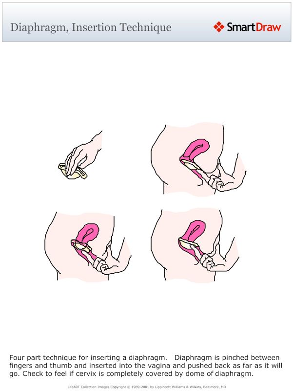 Diaphragm,_Insertion_Technique