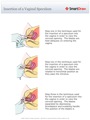 Insertion_of_a_Vaginal_Speculum
