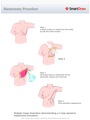 Mastectomy_Procedure