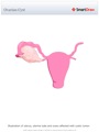 Ovarian_Cyst