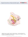 Vaginal_Insertion_of_Spermicidal_Agent