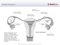 Ectopic_Pregnancy