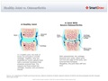 Healthy_Joint_vs._Osteoarthritis