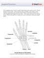 Scaphoid_Fractures