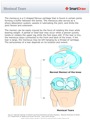 Meniscal_Tears