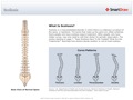 Scoliosis