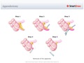 Appendectomy