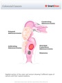 Colorectal_Cancers