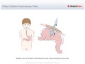 Foley_Catheter_Gastrostomy_Tube
