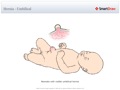 Hernia_-_Umbilical