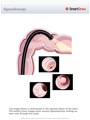 Sigmoidoscopy