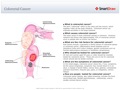 Colorectal_Cancer2