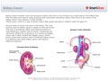 Kidney_Cancer
