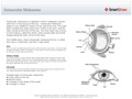 Intraocular_Melanoma