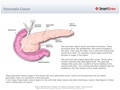 Pancreatic_Cancer