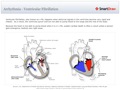 Arrhythmia_-_Ventricular_Fibrillation