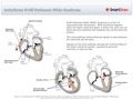 Arrhythmia_Wolff-Parkinson-White_Syndrome