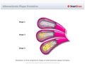 Atherosclerotic_Plaque_Formation