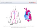 Cardiac_Catheterization