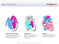 Heart_Valve_Defects