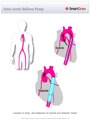 Intra-Aortic_Balloon_Pump