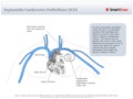 Implantable_Cardioverter_Defibrillator_(ICD)