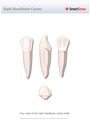 Right_Mandibular_Canine
