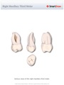 Right_Maxillary_Third_Molar