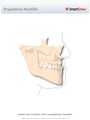 Prognathous_Mandible