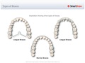 Types_of_Braces