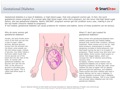 Gestational Diabetes