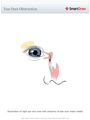 Tear Duct Obstruction