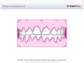 Gingival_Enlargement