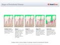 Stages_of_Periodontal_Disease