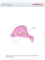 Nasal_Polyps