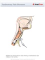 Tracheostomy_Tube_Placement