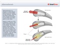 Atherosclerosis