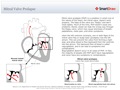 Mitral_Valve_Prolapse